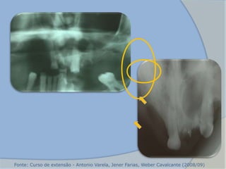 Fonte: Curso de extensão - Antonio Varela, Jener Farias, Weber Cavalcante (2008/09)
 