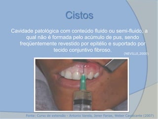Cavidade patológica com conteúdo fluido ou semi-fluido, a
qual não é formada pelo acúmulo de pus, sendo
freqüentemente revestido por epitélio e suportado por
tecido conjuntivo fibroso.
Cistos
(NEVILLE,2000)
Fonte: Curso de extensão - Antonio Varela, Jener Farias, Weber Cavalcante (2007)
 