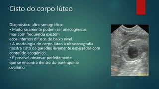 Cisto do corpo lúteo
Diagnóstico ultra-sonográfico:
• Muito raramente podem ser anecogênicos,
mas com freqüência existem
ecos internos difusos de baixo nível.
• A morfologia do corpo lúteo à ultrasonografia
mostra cisto de paredes levemente espessadas com
conteúdo ecogênico.
• É possível observar perfeitamente
que se encontra dentro do parênquima
ovariano
 
