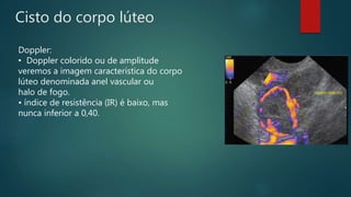 Cisto do corpo lúteo
Doppler:
• Doppler colorido ou de amplitude
veremos a imagem característica do corpo
lúteo denominada anel vascular ou
halo de fogo.
• índice de resistência (IR) é baixo, mas
nunca inferior a 0,40.
 