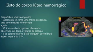 Cisto do corpo lúteo hemorrágico
Diagnóstico ultrassonográfico
• Apresenta-se como uma massa ecogênica,
caso tenha havido hemorragia
aguda.
• O líquido é heterogêneo, não sendo
observado em todo o volume da coleção.
• Sua parede externa é lisa e regular, porém mais
espessa que a do CFH.
 