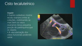 Cisto tecaluteínico
Doppler
• Exame cuidadoso mostra
tecido ovariano entre as
coleções, visibilizando-se
mais bem os vasos
ovarianos nessa pequena
porção do parênquima que
os separa.
• A vascularização dos
cistos funcionais podendo
variar.
 