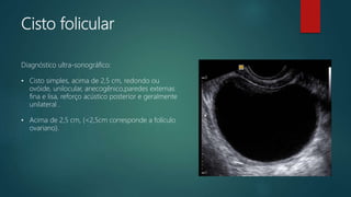Cisto folicular
Diagnóstico ultra-sonográfico:
• Cisto simples, acima de 2,5 cm, redondo ou
ovóide, unilocular, anecogênico,paredes externas
fina e lisa, reforço acústico posterior e geralmente
unilateral .
• Acima de 2,5 cm, (<2,5cm corresponde a folículo
ovariano).
 