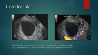 Cisto folicular
Cisto folicular. (A) O aspecto morfológico é característico de benignidade.
(B) O Doppler colorido de amplitude mostra vasos na periferia do ovário.
 