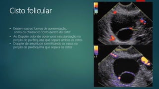 Cisto folicular
• Existem outras formas de apresentação,
como os chamados "cisto dentro do cisto".
• Ao Doppler colorido observa·se vascularização na
porção do parênquima que separa ambos os cistos
• Doppler de amplitude identificando os vasos na
porção de parênquima que separa os cistos
 