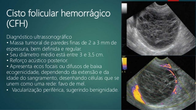 Cisto Hemorrágico No Ovário Direito – FUBJV