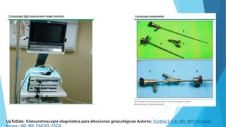 UpToDate: Cistouretroscopia diagnóstica para afecciones ginecológicas Autores: Cynthia S Fok, MD, MPH Kimberly
 