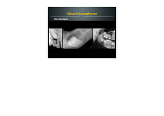 Cisto Dentígero
Cistos Odontogênicos
 