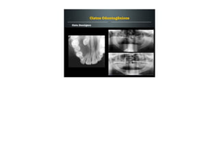 Cisto Dentígero
Cistos Odontogênicos
 