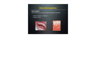 Cisto Gengival
Caracteriza-se por uma pequena tumefação em gengiva.
Recém nascido - múltiplos
Adulto - único
Cistos Odontogênicos
 