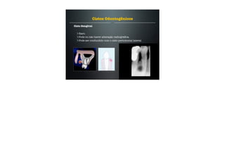 Cisto Gengival
Raro.
Pode ou não haver alteração radiográﬁca.
Pode ser confundido com o cisto periodontal lateral.
Cistos Odontogênicos
 