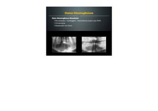 Cisto Odontogênico Glandular
Enucleação / curetagem - recorrência maior que 30%.
Crioterapia.
Ressecção em bloco.
Cistos Odontogênicos
 