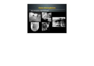 Cisto Periapical / Cisto Radicular
Cistos Odontogênicos
 