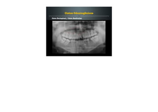 Cisto Periapical / Cisto Radicular
Cistos Odontogênicos
 