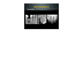 Cisto Residual
Cistos Odontogênicos
 