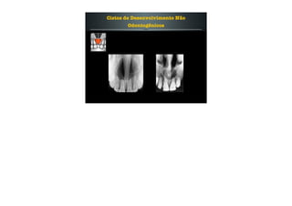 Cistos de Desenvolvimento Não
Odontogênicos
 