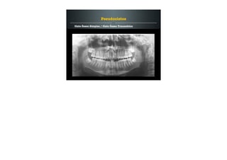 Cisto Ósseo Simples / Cisto Ósseo Traumático
Pseudocistos
 
