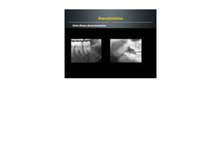 Cisto Ósseo Aneurismático
Pseudocistos
 