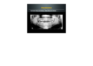 Cavidade Óssea de Stafne / Cisto Ósseo de Stafne
Pseudocistos
 