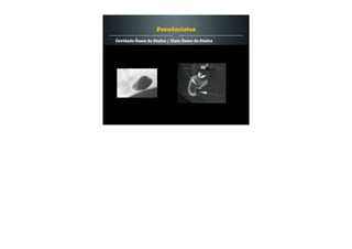 Cavidade Óssea de Stafne / Cisto Ósseo de Stafne
Pseudocistos
 