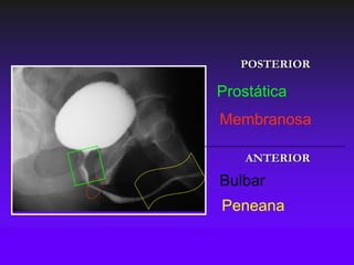POSTERIOR

Prostática
Membranosa

    ANTERIOR

Bulbar
Peneana
 