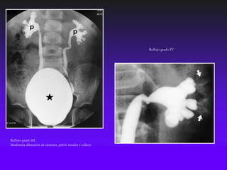Reflujo grado IV




Reflujo grado III
Moderada dilatación de ureteres, pelvis renales y calices
 