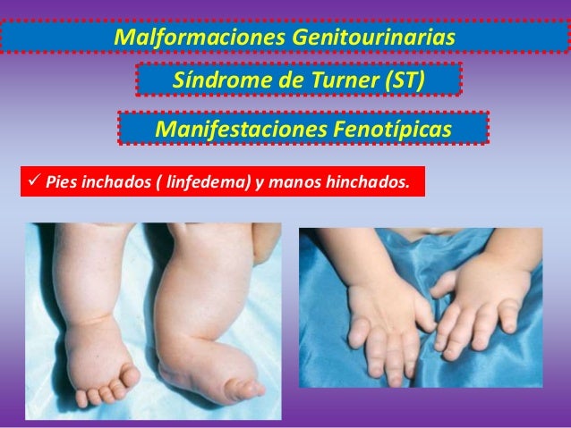 Citogenetica malformaciones genitourinaria- Sindrome de Turner
