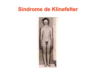 Síndrome de Klinefelter

 