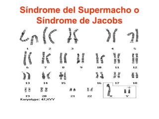 Síndrome del Supermacho o
Síndrome de Jacobs

 