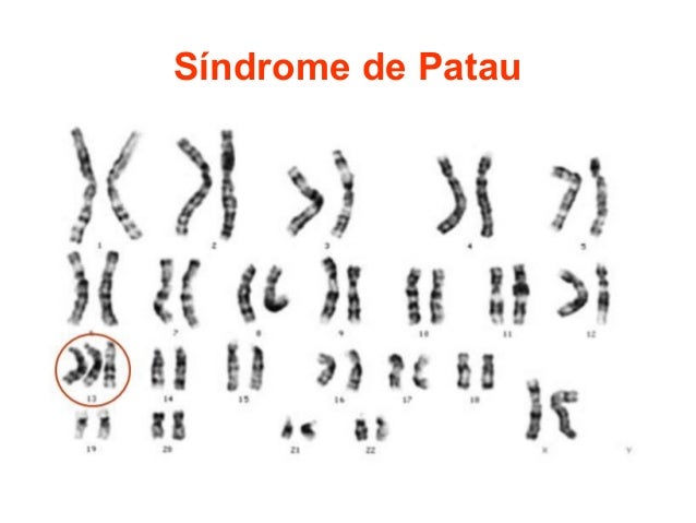 Resultado de imagen para cariotipo sindrome de patau
