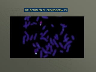92%.
No disyunción de células
germinativas durante la
gametogénesis materna
(trisomía libre)
5%
Translocación de cromosoma...