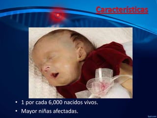 Características

• 1 por cada 6,000 nacidos vivos.
• Mayor niñas afectadas.

 