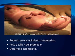 • Retardo en el crecimiento intrauterino.
• Peso y talla < del promedio.
• Desarrollo incompleto.

 