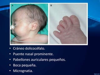 •
•
•
•
•

Cráneo dolicocéfalo.
Puente nasal prominente.
Pabellones auriculares pequeños.
Boca pequeña.
Micrognatia.

 