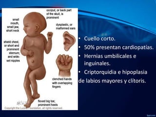 • Cuello corto.
• 50% presentan cardiopatías.
• Hernias umbilicales e
inguinales.
• Criptorquidia e hipoplasia
de labios mayores y clítoris.

 