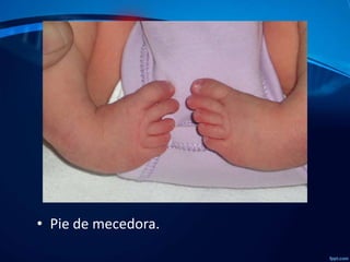 • Pie de mecedora.

 