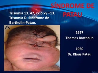 Trisomía 13. 47, xx ó xy +13.
Trisomía D. Síndrome de
Bartholin-Patau.
1657
Thomas Bartholin
1960
Dr. Klaus Patau

 