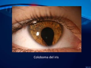 Coloboma del iris

 