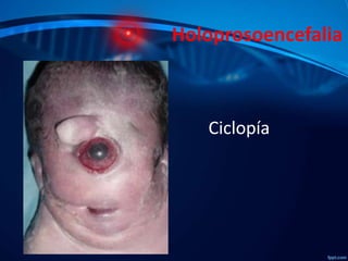 Holoprosoencefalia

Ciclopía

 