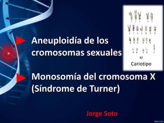 ► Aneuploidía de los
cromosomas sexuales
Cariotipo

► Monosomía del cromosoma X
(Síndrome de Turner)
Jorge Soto

 