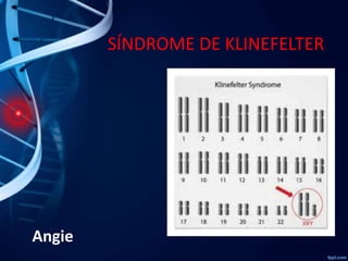 SÍNDROME DE KLINEFELTER

Angie

 