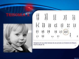 Trisomía x

 