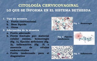 CITOLOGÍA CERVICOVAGINAL
LO QUE SE INFORMA EN EL SISTEMA BETHESDA
1. Tipo de muestra
a. Frotis convencional
b. Base líquida
c. Otros
2. Adecuación de la muestra
a. Frotis adecuado
b. Frotis limitado por: material
celular escaso, hemorragia
(fig. 1), fijación deficiente (fig.
2), inflamación (fig. 3) o
ausencia de células
endocervicales
c. Frotis inadecuado para el
diagnóstico
Fig. 1. Hemorragia
Fig. 2. Fijación
insuficiente
Fig. 3. Inflamación
 