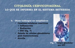 b. Otros hallazgos no neoplásicos
 Cambios celulares reactivos
 Inflamación
 Radiación
 DIU (fig. 7)
 Estado de células glandulares
post-histerectomía
 Atrofia
CITOLOGÍA CERVICOVAGINAL
LO QUE SE INFORMA EN EL SISTEMA BETHESDA
Fig. 7. Atipia glandular
por DIU
 