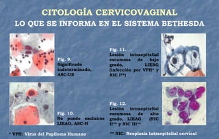 CITOLOGÍA CERVICOVAGINAL
LO QUE SE INFORMA EN EL SISTEMA BETHESDA
Fig. 9.
Significado
indeterminado,
ASC-US
Fig. 10.
No puede excluirse
LIEAG, ASC-H
Fig. 11.
Lesión intraepitelial
escamosa de bajo
grado, LIEBG
(infección por VPH* y
NIC I**)
Fig. 12.
Lesión intraepitelial
escamosa de alto
grado, LIEAG (NIC
II** y NIC III**
* VPH: Virus del Papiloma Humano ** NIC: Neoplasia intraepitelial cervical
 