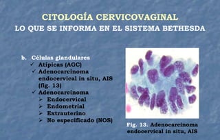 b. Células glandulares
 Atípicas (AGC)
 Adenocarcinoma
endocervical in situ, AIS
(fig. 13)
 Adenocarcinoma
 Endocervical
 Endometrial
 Extrauterino
 No especificado (NOS)
CITOLOGÍA CERVICOVAGINAL
LO QUE SE INFORMA EN EL SISTEMA BETHESDA
Fig. 13. Adenocarcinoma
endocervical in situ, AIS
 