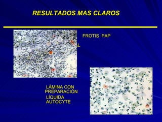 RESULTADOS MAS CLAROS         LÁMINA CON    PREPARACIÓN   LÍQUIDA    AUTOCYTE         FROTIS  PAP    CONVENCIONAL Cortesía: 