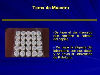 Se tapa el vial marcado que contiene la cabeza del cepillo. - Se pega la etiqueta del laboratorio con sus datos y se envía al Laboratorio de Patología .  Toma de Muestra 