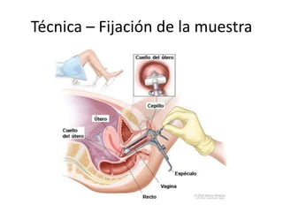 Técnica – Fijación de la muestra
 