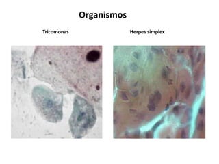 Organismos
Tricomonas                Herpes simplex
 